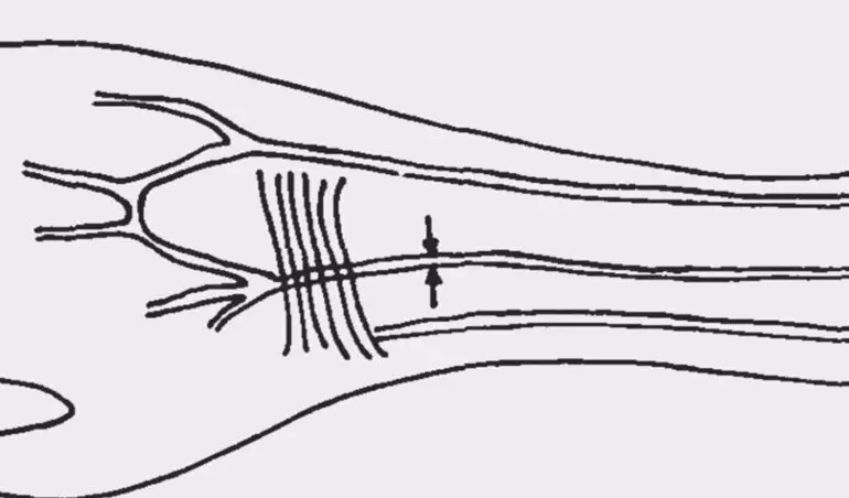 Descripci&oacute;n de la arteria mediana en el antebrazo - MACIEJ HENNEBERG, UNIVERSITY OF ADELAIDE