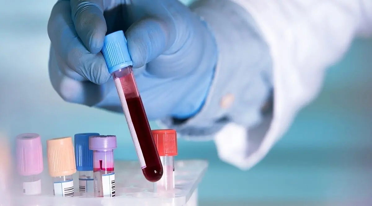 Archivo - Un simple an&aacute;lisis de sangre basta para detectar positividad por