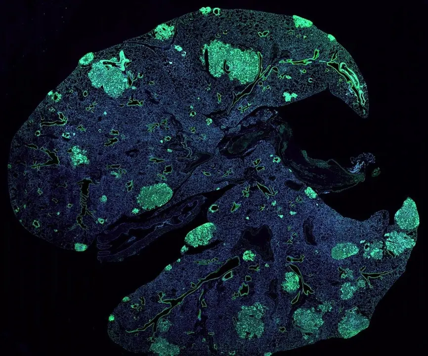 Archivo - Pulm&oacute;n de rat&oacute;n con met&aacute;stasis (verde) formado por c&eacute;lulas cancerosas que se diseminan desde un tumor de mama primario.