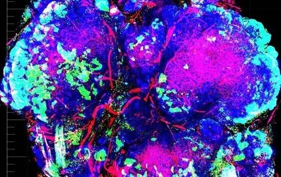 Tumor con zonas de hipoxia en color verde. /