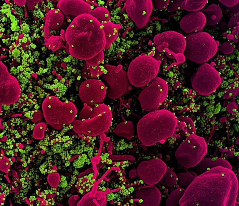 Archivo - Micrograf&iacute;a electr&oacute;nica de barrido coloreada de una c&eacute;lula apopt&oacute;tica (rosa) muy infectada con part&iacute;culas del virus SARS-COV-2 (verde), aislada de una muestra de un paciente.