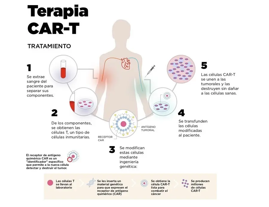 Archivo - Infograf&iacute;a sobre el funcionamiento de las CAR-T