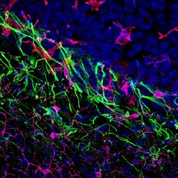 Met&aacute;stasis cerebral de melanoma en rat&oacute;n.