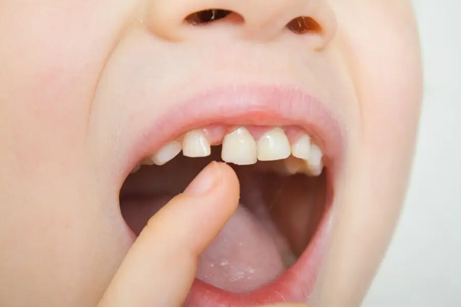 Archivo - Dientes de leche, dientes de ni&ntilde;o, boca de ni&ntilde;o