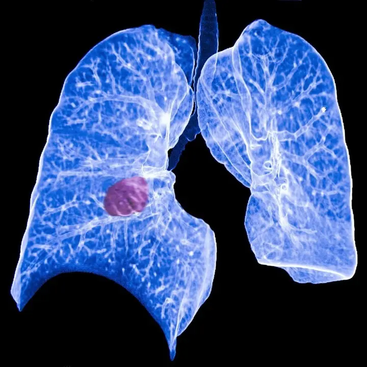Archivo - C&aacute;ncer de pulm&oacute;n