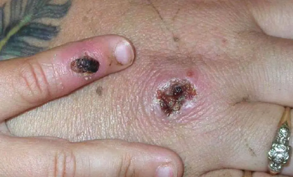La denominada "viruela del mono" o "viruela s&iacute;mica" &mdash;monkeypox en ingl&eacute;s&mdash; ha hecho sonar las alarmas en Europa y Estados Unidos.