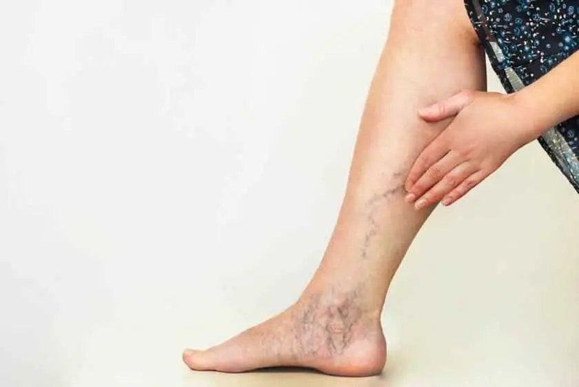 Una persona con varices en la pierna. / EP