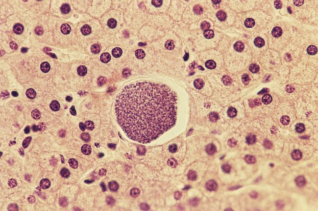 Micrografía de Plasmodium vivax, un parásito que causa la malaria, en una sección del hígado humano.
Crédito...Biophoto Associates/Science Source