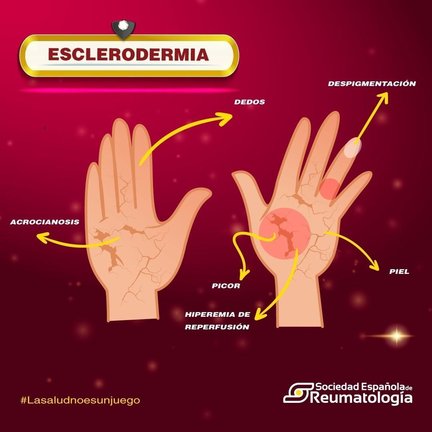 La Sociedad Española de Reumatología se une a la celebración del ‘Día Mundial de la Esclerodermia’