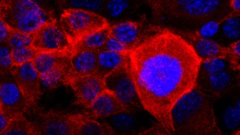 La mayoría de las células de cáncer de páncreas tienen mutaciones en el gen KRAS que permiten un crecimiento no regulado. En esta imagen, la versión mutante y cancerígena de la proteína KRAS se tiñe de rojo en las células de cáncer de páncreas.