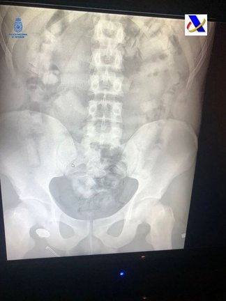 Radiografía con los cilindos de cocaína que portaba el hombre detenido en Palma.