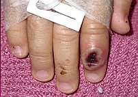 Fotograf??a de archivo del Centro Estadounidense de Control de las Enfermedades (CDC) en la que se aprecia el dedo de un ni??o infectado por la llamada ""viruela de mono"" (monkeypox). EFE/Cortes??a CDC