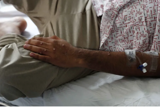 Una persona afectada por la viruela del mono. EFE/Paolo Aguilar/Archivo