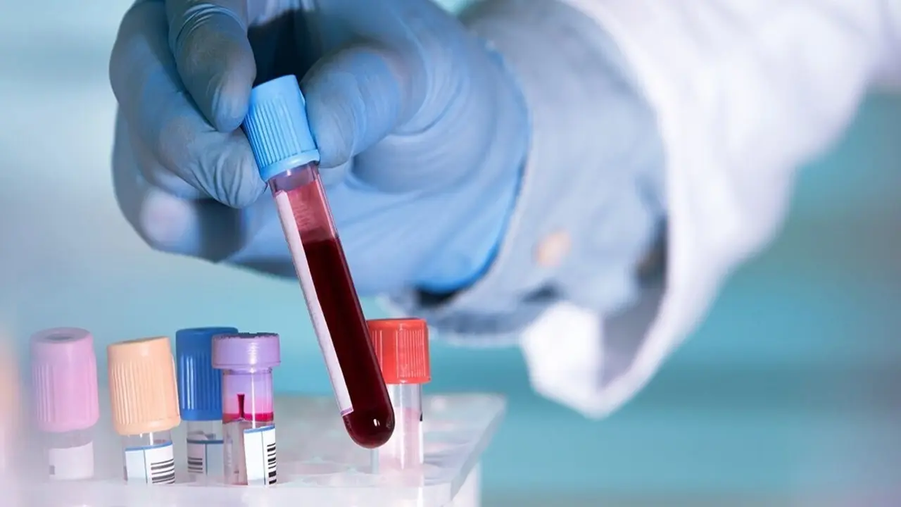 Archivo - Un simple an&aacute;lisis de sangre basta para detectar positividad por