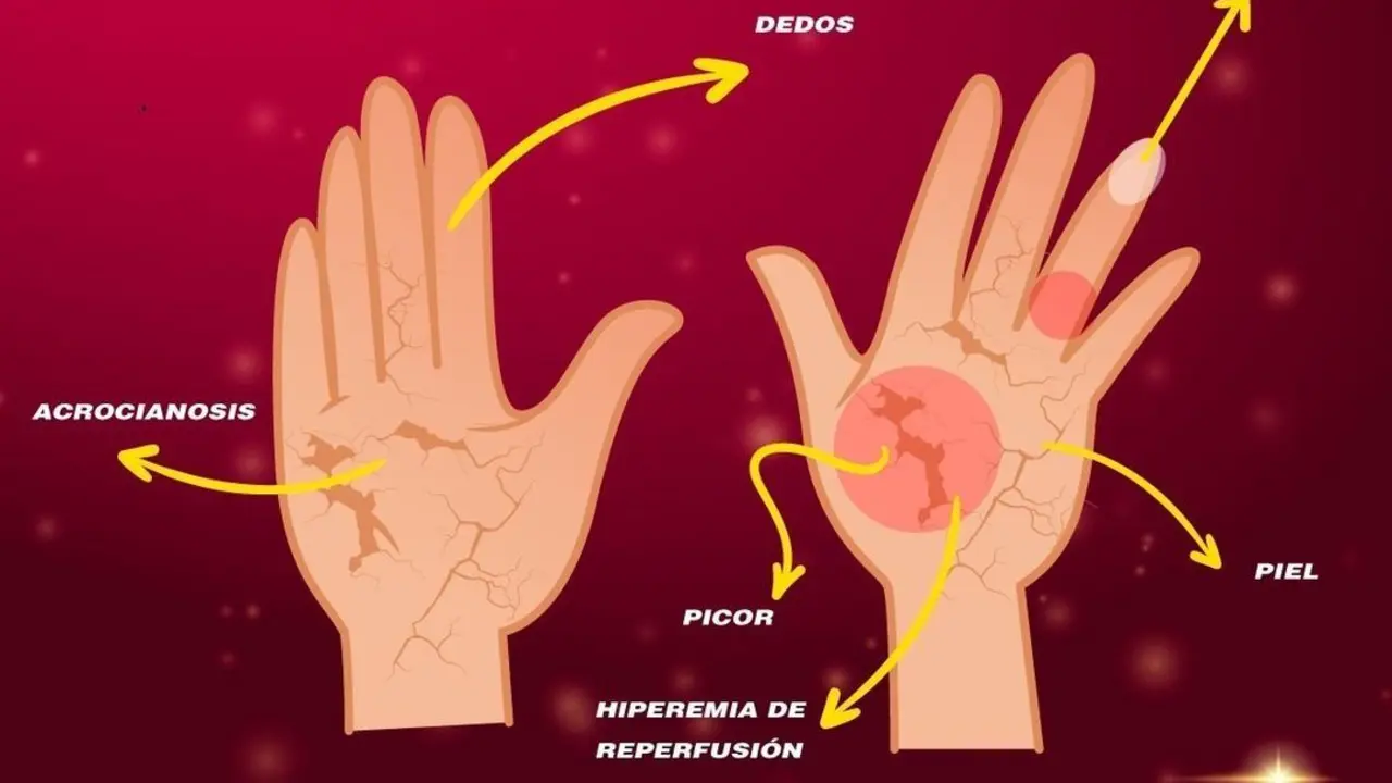 La Sociedad Espa&ntilde;ola de Reumatolog&iacute;a se une a la celebraci&oacute;n del &lsquo;D&iacute;a Mundial de la Esclerodermia&rsquo;