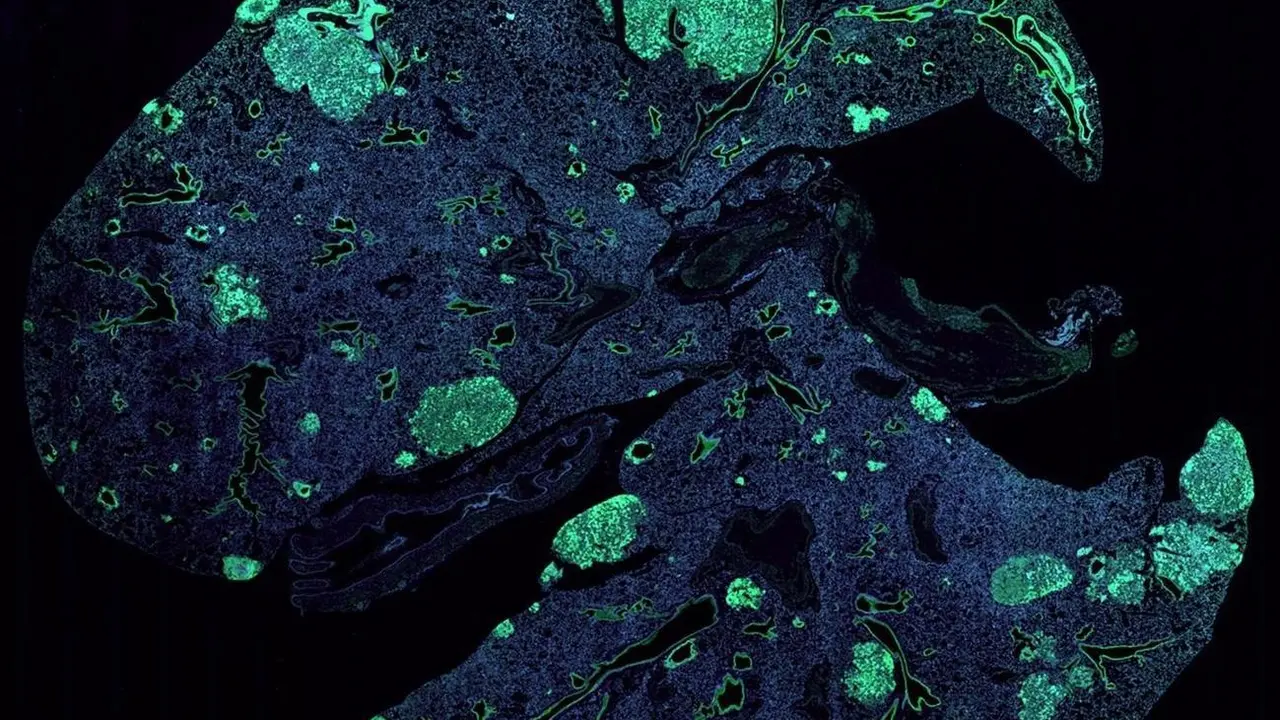Archivo - Pulm&oacute;n de rat&oacute;n con met&aacute;stasis (verde) formado por c&eacute;lulas cancerosas que se diseminan desde un tumor de mama primario.