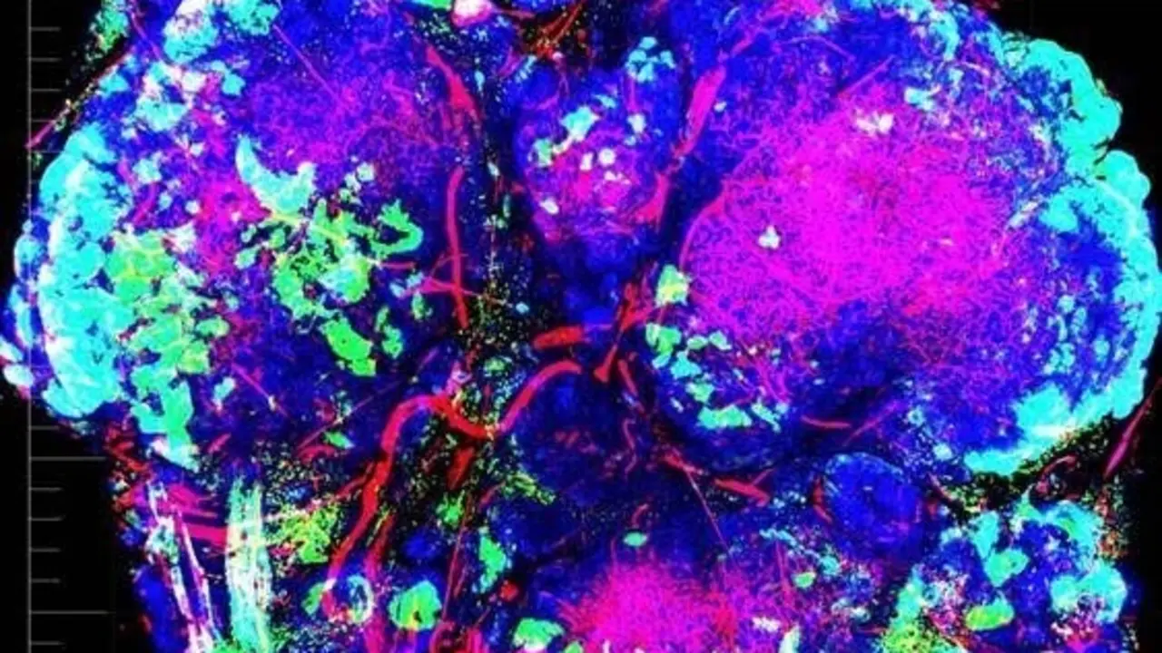 Tumor con zonas de hipoxia en color verde. /