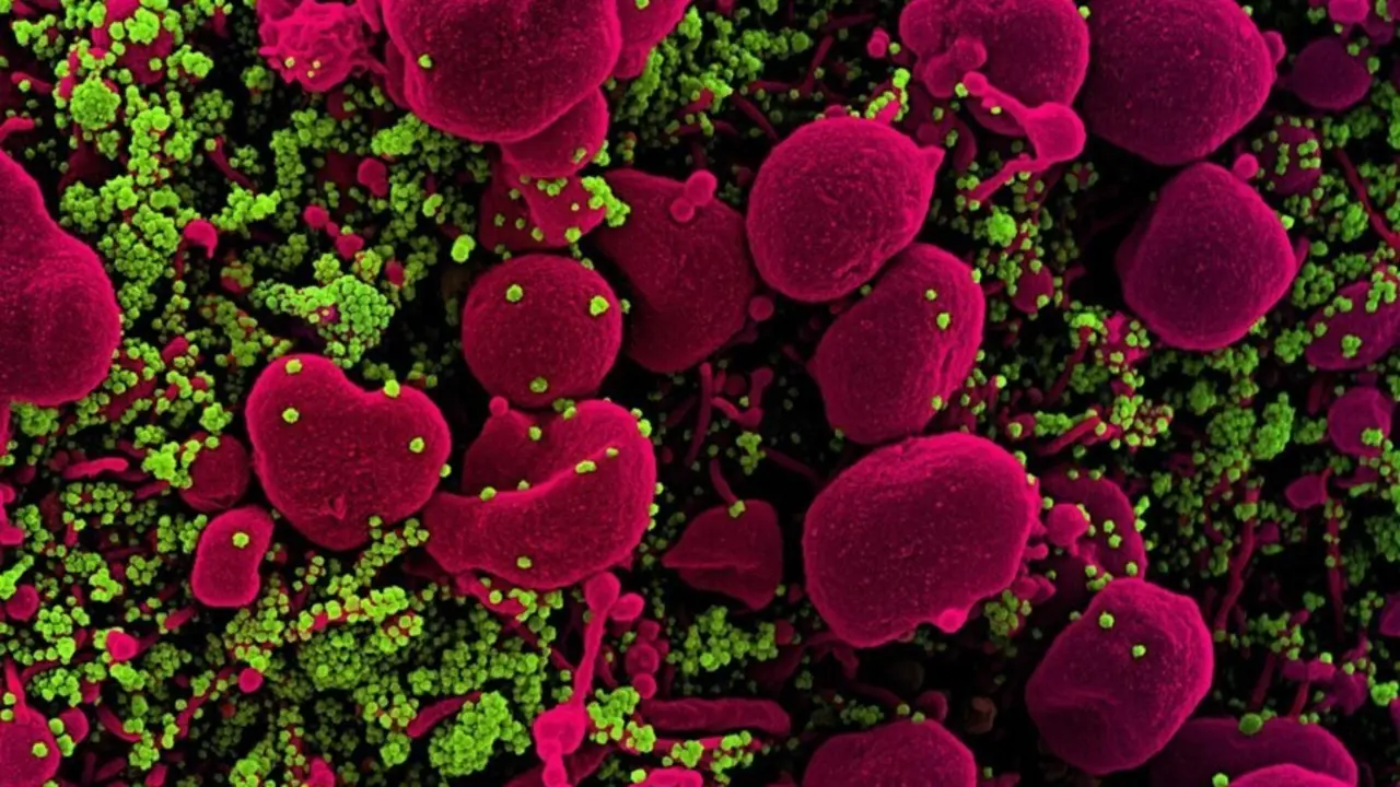 Archivo - Micrograf&iacute;a electr&oacute;nica de barrido coloreada de una c&eacute;lula apopt&oacute;tica (rosa) muy infectada con part&iacute;culas del virus SARS-COV-2 (verde), aislada de una muestra de un paciente.
