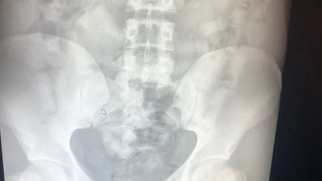 Radiograf&iacute;a con los cilindos de coca&iacute;na que portaba el hombre detenido en Palma.