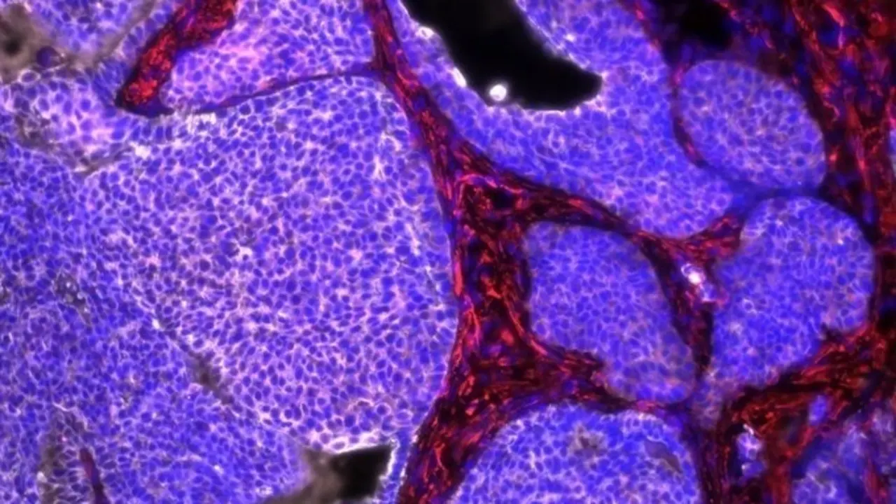 C&aacute;ncer de mama de rat&oacute;n con el componente no tumoral (rojo) y las c&eacute;lulas tumorales (blanco).
