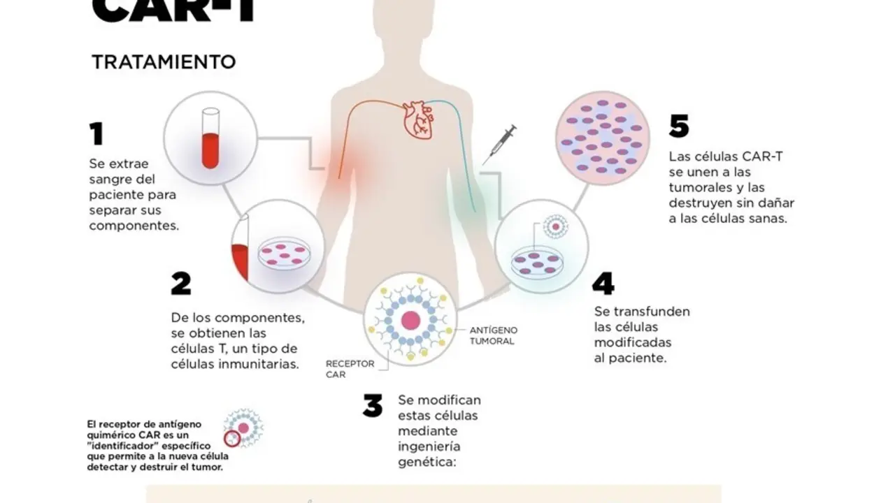 Archivo - Infograf&iacute;a sobre el funcionamiento de las CAR-T
