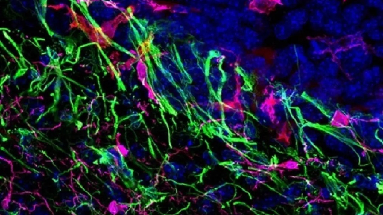 Met&aacute;stasis cerebral de melanoma en rat&oacute;n.
