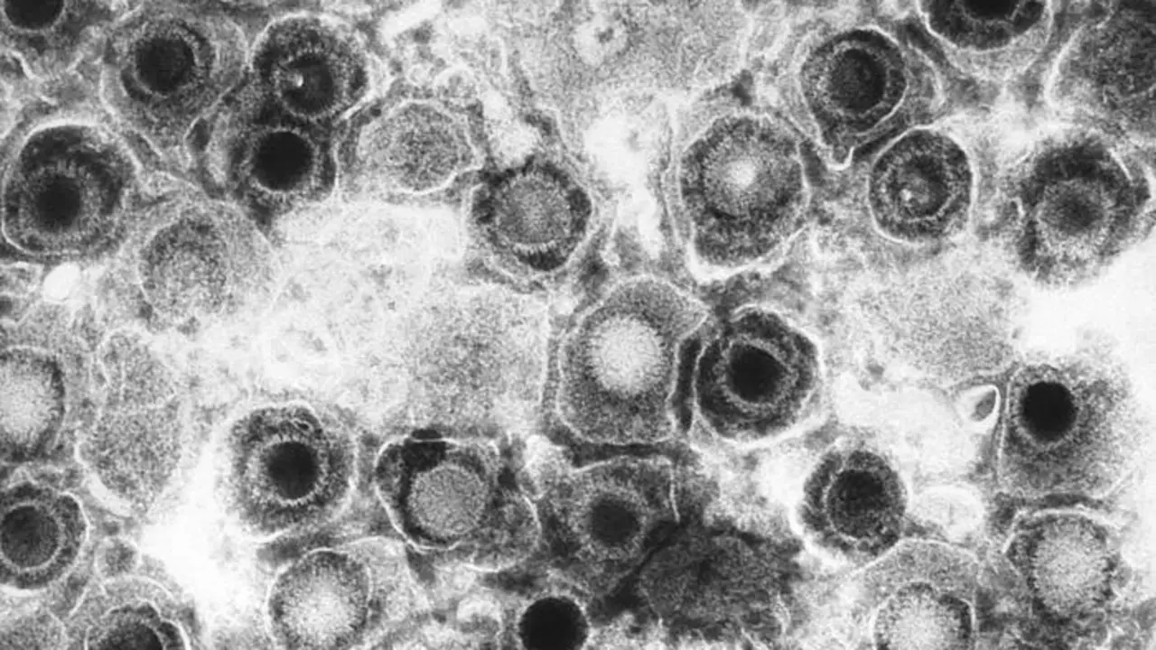 Archivo - Herpes Simple Virus