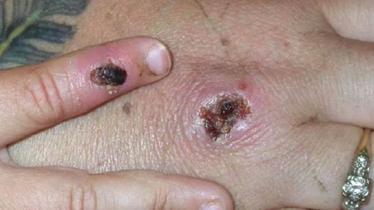 La denominada "viruela del mono" o "viruela s&iacute;mica" &mdash;monkeypox en ingl&eacute;s&mdash; ha hecho sonar las alarmas en Europa y Estados Unidos.