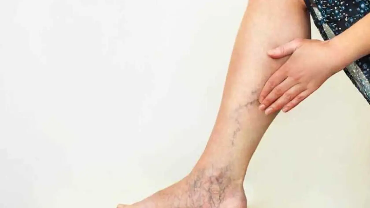 Una persona con varices en la pierna. / EP